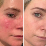 Load image into Gallery viewer, Amiro R1 PRO Facial RF Skin Tightening Device
