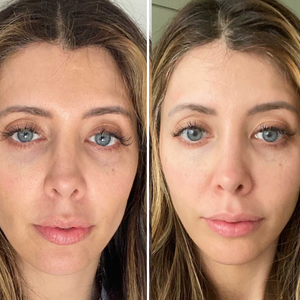 Amiro R1 PRO Facial RF Skin Tightening Device