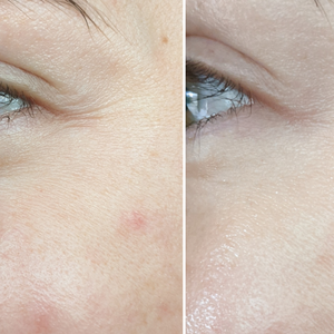 Amiro R1 PRO Facial RF Skin Tightening Device